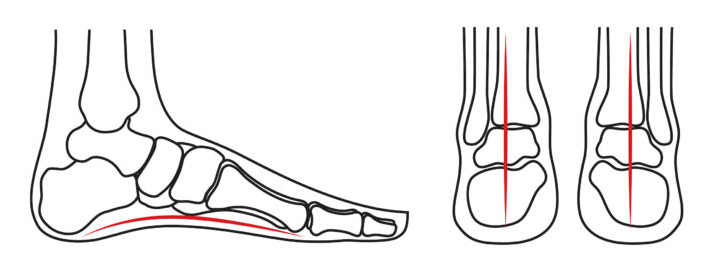 How To Prevent Achilles Pain After Running 2021 Normal Foot