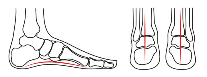 What Causes Achilles Pain When Running Normal Foot Alignment